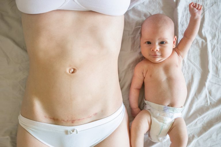 Here’s What I’ve Learned After Six C-Sections